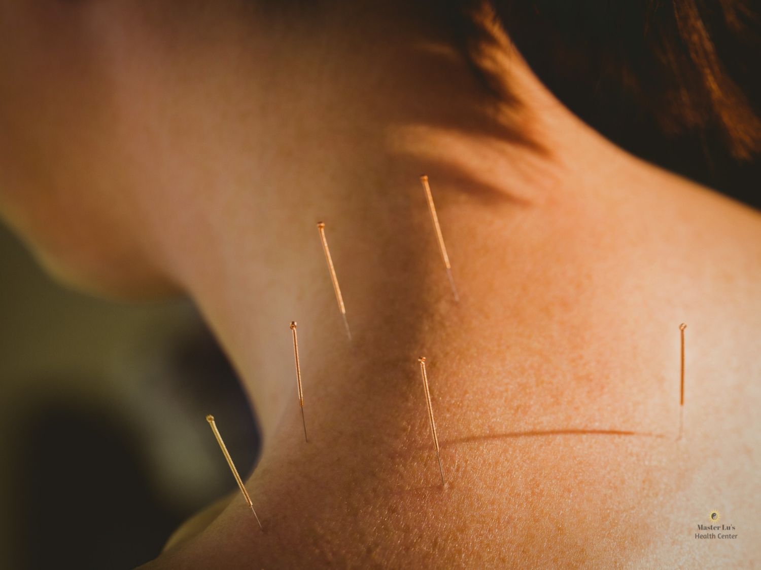 Acupuncture Services in Salt Lake City Utah